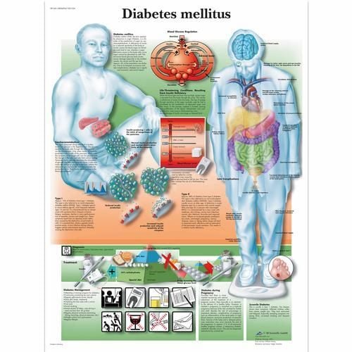 Image 1 of 3B Scientific Diabetes Mellitus Chart