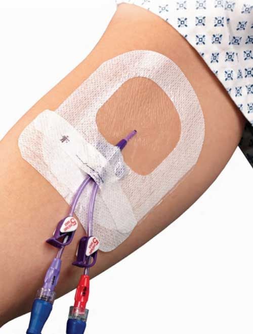 IV Securement