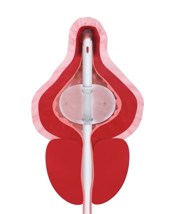 Traditional Foley Catheter Tip Damaging Bladder