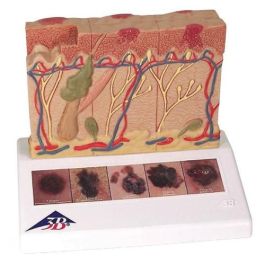 3B Scientific Skin Cancer Model | J15 | Vitality Medical