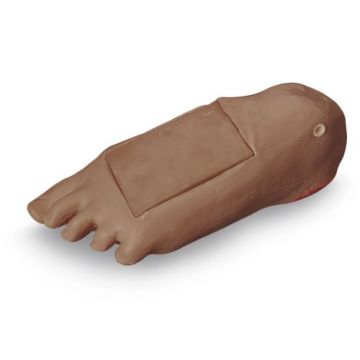 Optional Edema Foot with Deep Tissue Injury