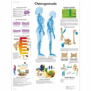 3B Scientific Osteoporosis Chart
