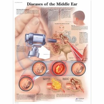3B Scientific Diseases of the Middle Ear Chart