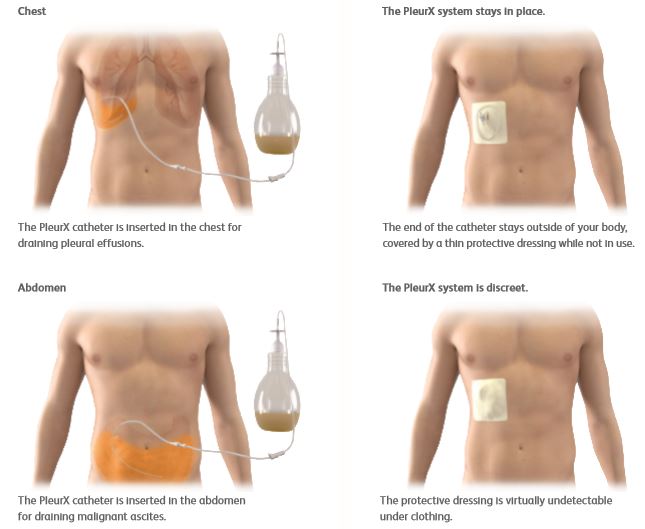 PleurX Drainage System Catheter Placement