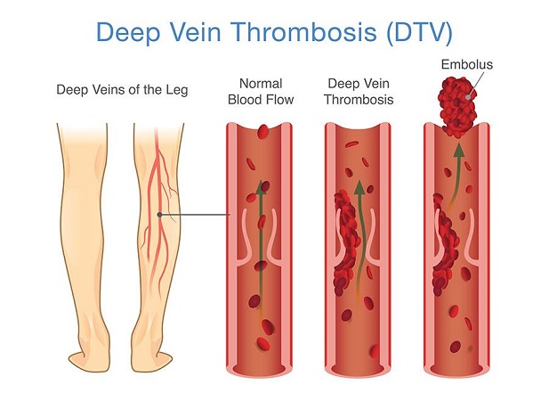 Deep vein thrombosis illustration