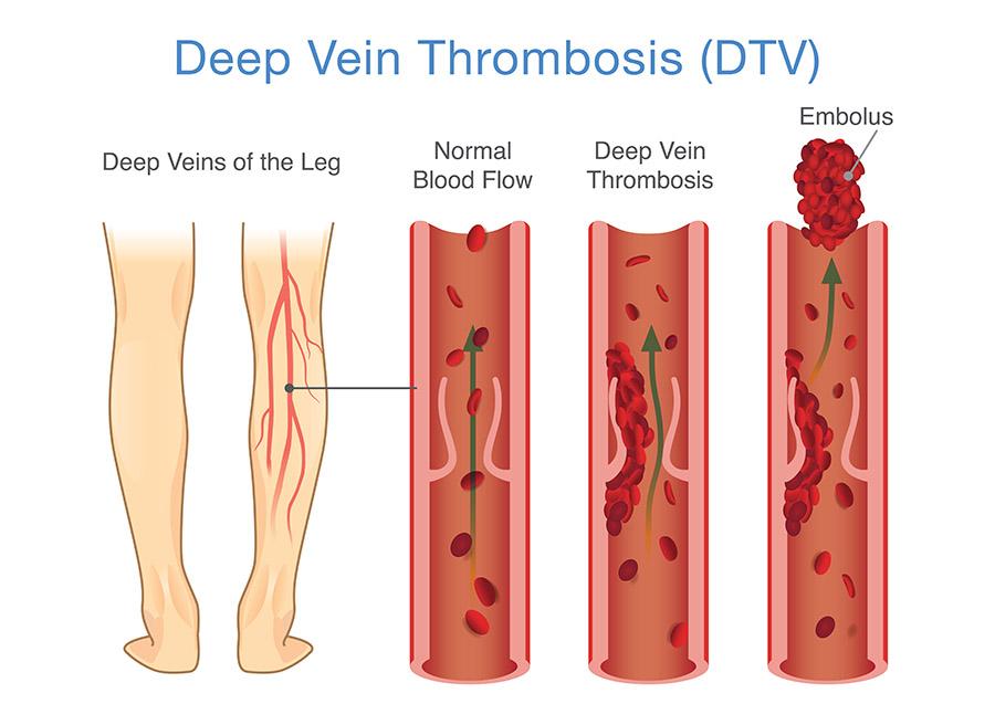 Deep Vein Thrombosis