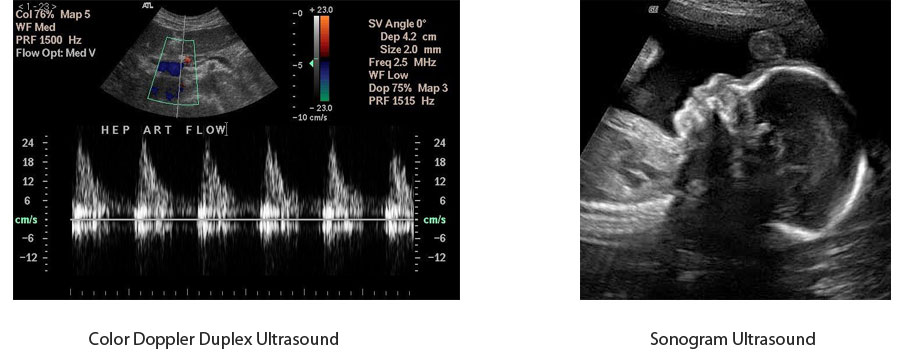 DU vs. Sonogram