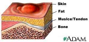 illustration of Stage one wound
