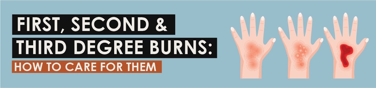 First, Second, and Third Degree Burns: How to Care for Them