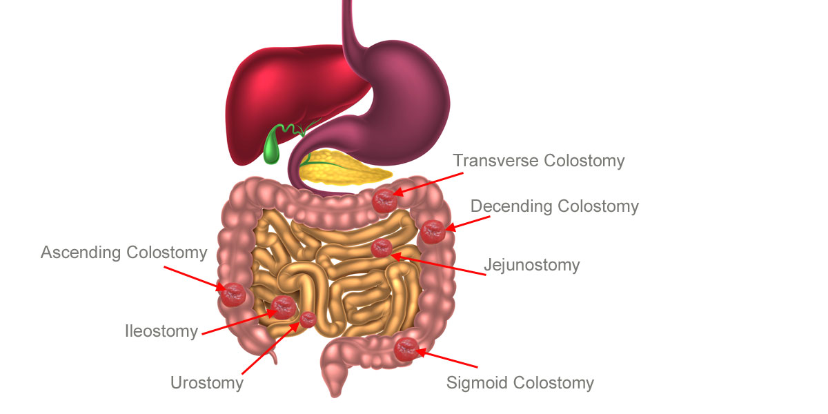 Ostomy Locations