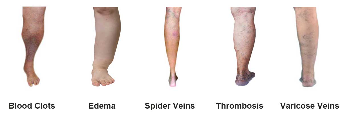 Venous Insufficiency Illnesses