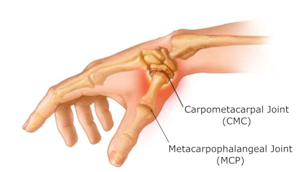 CMC and MCP Joints