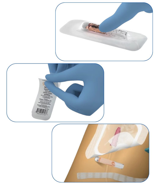 A gloved hand using the ultra-easy Detachol vial on a clear dressing.