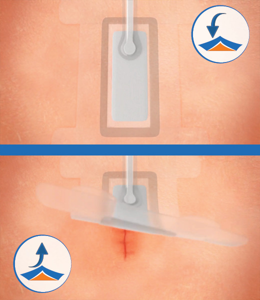 Skin with a wound, showing the application and removal of PICO 7 dressing.