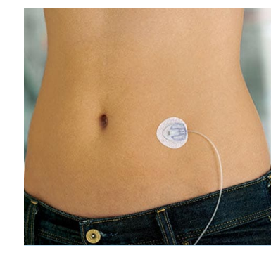 Insulin Infusion Set Implanted on Abdomen