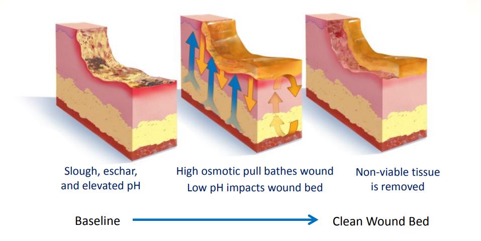 Mediohoney Debridement