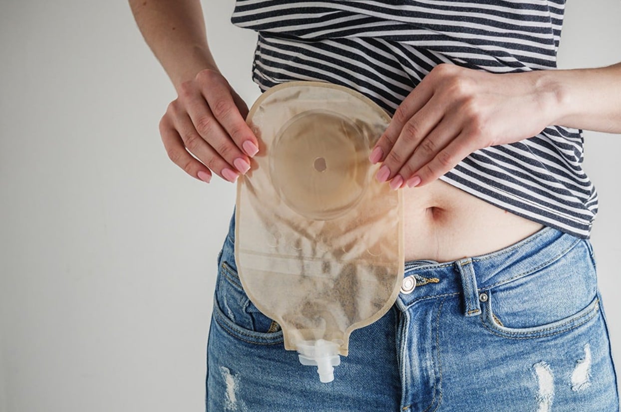 Woman holds an ostomy pouch up to her abdomen