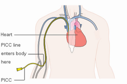 PICC Line Placement