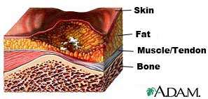 illustration of Stage three wound